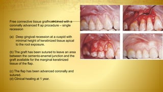 Free connective tissue graft combined with a
coronally advanced fl ap procedure – single
recession
(a) Deep gingival recession at a cuspid with
minimal height of keratinized tissue apical
to the root exposure.
(b) The graft has been sutured to leave an area
between the cemento-enamel junction and the
graft available for the marginal keratinized
tissue of the flap.
(c) The flap has been advanced coronally and
sutured.
(d) Clinical healing at 1 year.
 
