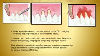 a. Make a partial-thickness horizontal incision on the CEJ or slightly
coronally and perpendicular to the interdental papilla.
b. Connect each horizontal incision with a sulcular incision. Extend the
incision mesiodistally and prepare a large flap for proper access.
After reflecting a partial-thickness flap, prepare a periosteum-connective
tissue recipient site. Extend the partial-thickness incision apically
for coronal migration of the flap.
 
