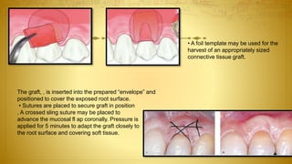 • A foil template may be used for the
harvest of an appropriately sized
connective tissue graft.
The graft, , is inserted into the prepared “envelope” and
positioned to cover the exposed root surface.
• Sutures are placed to secure graft in position
. A crossed sling suture may be placed to
advance the mucosal fl ap coronally. Pressure is
applied for 5 minutes to adapt the graft closely to
the root surface and covering soft tissue.
 