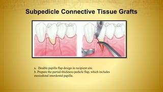 Subpedicle Connective Tissue Grafts
a. Double papilla flap design in recipient site.
b. Prepare the partial-thickness pedicle flap, which includes
mesiodistal interdental papilla.
 