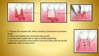 c. Prepare the recipient site, which consists of periosteum-connective
tissue.
d. Suture and stabilize the connective tissue graft.
e. Connect each papilla flap to make a double papilla flap.
f. Cover the connective tissue graft on the root surface with the double
papilla flap. Make a sling suture.
 