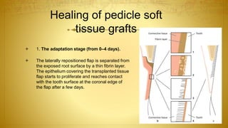 Healing of pedicle soft
tissue grafts
 1. The adaptation stage (from 0–4 days).
 The laterally repositioned flap is separated from
the exposed root surface by a thin fibrin layer.
The epithelium covering the transplanted tissue
flap starts to proliferate and reaches contact
with the tooth surface at the coronal edge of
the flap after a few days.
 