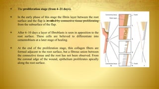  The proliferation stage (from 4–21 days).
 In the early phase of this stage the fibrin layer between the root
surface and the flap is invaded by connective tissue proliferating
from the subsurface of the flap.
 After 6–10 days a layer of fibroblasts is seen in apposition to the
root surface. These cells are believed to differentiate into
cementoblasts at a later stage of healing.
 At the end of the proliferation stage, thin collagen fibers are
formed adjacent to the root surface, but a fibrous union between
the connective tissue and the root has not been observed. From
the coronal edge of the wound, epithelium proliferates apically
along the root surface.
 