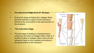  The attachment stage (from 27–28 days).
 During this stage of healing thin collagen fibers
become inserted in a layer of new cementum
formed at the root surface in the apical portion of
the recession.
 The maturation stage.
 This last stage of healing is characterized by
continuous formation of collagen fibers. After 2–3
months bundles of collagen fibers insert into the
cementum layer on the curetted root surface in
the apical portion of the recession.
 