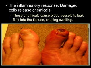 • The inflammatory response: Damaged
cells release chemicals.
– These chemicals cause blood vessels to leak
fluid into the tissues, causing swelling.
– This helps isolate the foreign substance from
further contact with body tissues.
 