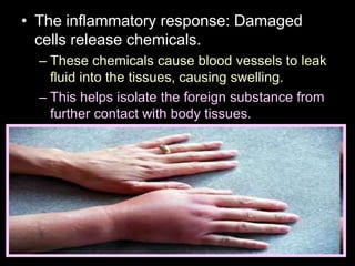 • The inflammatory response: Damaged
cells release chemicals.
– These chemicals cause blood vessels to leak
fluid into the tissues, causing swelling.
– This helps isolate the foreign substance from
further contact with body tissues.
 
