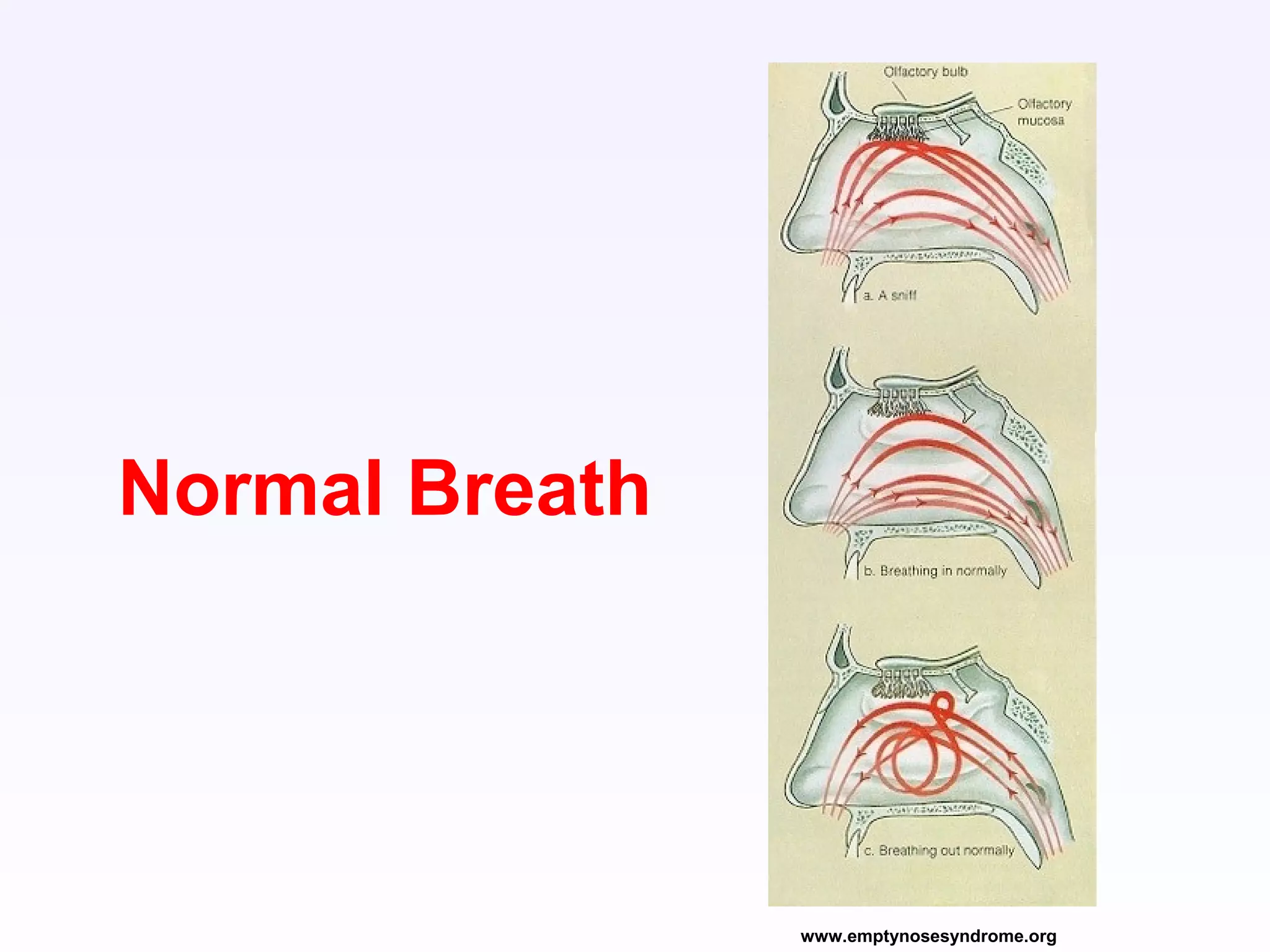 www.emptynosesyndrome.org
Normal Breath
 