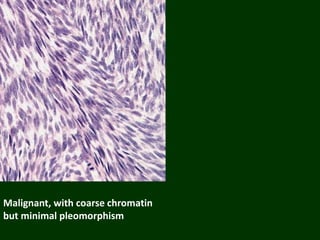 Malignant, with coarse chromatin
but minimal pleomorphism
 