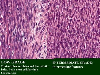 LOW GRADE
Minimal pleomorphism and low mitotic
index, but is more cellular than
fibromatosis
INTERMEDIATE GRADE:
intermediate features
 