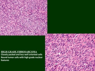 HIGH GRADE FIBROSARCOMA
Closely packed and less well oriented cells
Round tumor cells with high grade nuclear
features
 