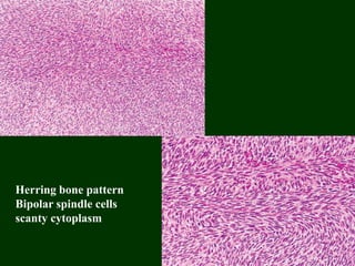 Herring bone pattern
Bipolar spindle cells
scanty cytoplasm
 