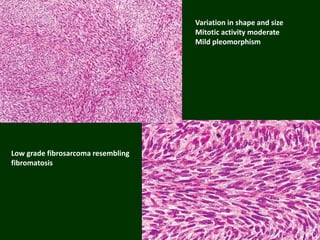 Low grade fibrosarcoma resembling
fibromatosis
Variation in shape and size
Mitotic activity moderate
Mild pleomorphism
 