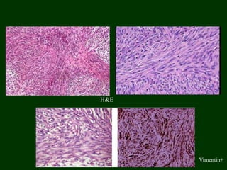H&E
Vimentin+
 