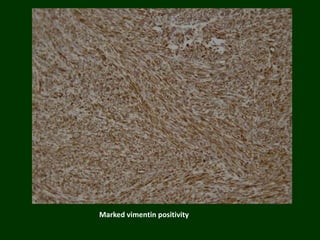 Marked vimentin positivity
 