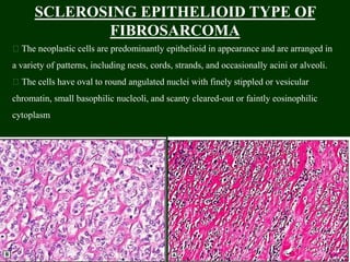 SCLEROSING EPITHELIOID TYPE OF
FIBROSARCOMA
The neoplastic cells are predominantly epithelioid in appearance and are arranged in
a variety of patterns, including nests, cords, strands, and occasionally acini or alveoli.
The cells have oval to round angulated nuclei with finely stippled or vesicular
chromatin, small basophilic nucleoli, and scanty cleared-out or faintly eosinophilic
cytoplasm
 