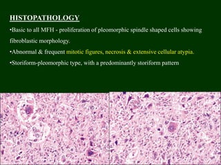 HISTOPATHOLOGY
•Basic to all MFH - proliferation of pleomorphic spindle shaped cells showing
fibroblastic morphology.
•Abnormal & frequent mitotic figures, necrosis & extensive cellular atypia.
•Storiform-pleomorphic type, with a predominantly storiform pattern
 