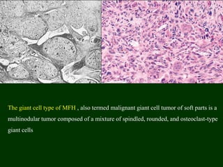 The giant cell type of MFH , also termed malignant giant cell tumor of soft parts is a
multinodular tumor composed of a mixture of spindled, rounded, and osteoclast-type
giant cells
 