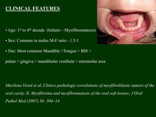 CLINICAL FEATURES
• Age: 1st to 4th decade (Infants – Myofibromatosis)
• Sex: Common in males M-F ratio - 1.5:1
• Site: Most common Mandible >Tongue > BM >
palate > gingiva > mandibular vestibule > retromolar area
Marilena Vered et al, Clinico-pathologic correlations of myofibroblastic tumors of the
oral cavity. II. Myofibroma and myofibromatosis of the oral soft tissues; J Oral
Pathol Med (2007) 36: 304–14
 