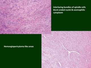 Hemangiopericytoma like areas
Interlacing bundles of spindle cells
blunt-ended nuclei & eosinophilic
cytoplasm
 