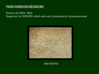 IMMUNOHISTOCHEMISTRY
Positive for SMA, MSA
Negativity for DESMIN which rules out Leiomyoma & Leiomyosarcoma
SMA POSITIVE
 