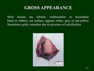 Most lesions are lobular, multinodular or bosselated.
Hard or rubbery cut surface, appears white, grey or tan-yellow.
Sometimes gritty sensation due to presence of calcification
GROSS APPEARANCE
163
 