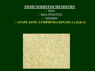 IMMUNOHISTOCHEMISTRY
SMA
MSA POSITIVE
DESMIN
ANAPLASTIC LYMPHOMA KINASE-1 (ALK-1)
 