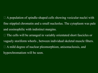 A population of spindle-shaped cells showing vesicular nuclei with
fine stippled chromatin and a small nucleolus. The cytoplasm was pale
and eosinophilic with indistinct margins.
The cells will be arranged in variably orientated short fascicles or
vaguely storiform whorls , between individual skeletal muscle fibers.
A mild degree of nuclear pleomorphism, anisonucleosis, and
hyperchromatism will be seen.
 
