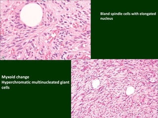 Myxoid change
Hyperchromatic multinucleated giant
cells
Bland spindle cells with elongated
nucleus
 