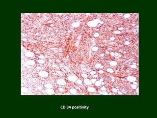 CD 34 positivity
 