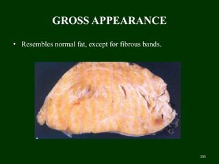 GROSS APPEARANCE
• Resembles normal fat, except for fibrous bands.
195
 