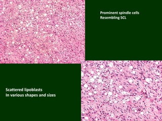Scattered lipoblasts
In various shapes and sizes
Prominent spindle cells
Resembling SCL
 