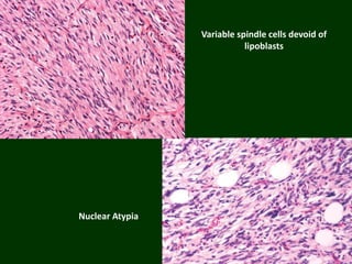 Nuclear Atypia
Variable spindle cells devoid of
lipoblasts
 
