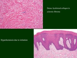 Hyperkeratosis due to irritation
Dense, hyalinized collagen in
sclerotic fibroma
 