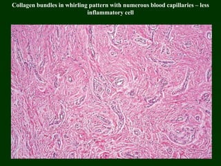 Collagen bundles in whirling pattern with numerous blood capillaries – less
inflammatory cell
 
