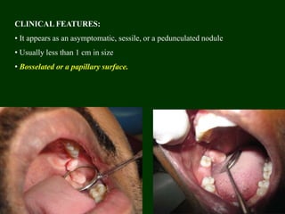 CLINICAL FEATURES:
• It appears as an asymptomatic, sessile, or a pedunculated nodule
• Usually less than 1 cm in size
• Bosselated or a papillary surface.
 