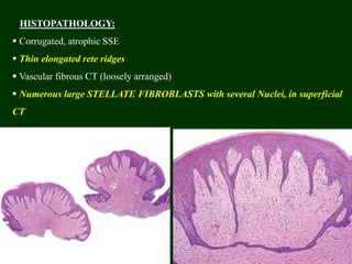 HISTOPATHOLOGY:
 Corrugated, atrophic SSE
 Thin elongated rete ridges
 Vascular fibrous CT (loosely arranged)
 Numerous large STELLATE FIBROBLASTS with several Nuclei, in superficial
CT
 