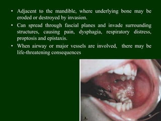 • Adjacent to the mandible, where underlying bone may be
eroded or destroyed by invasion.
• Can spread through fascial planes and invade surrounding
structures, causing pain, dysphagia, respiratory distress,
proptosis and epistaxis.
• When airway or major vessels are involved, there may be
life-threatening consequences
42
 
