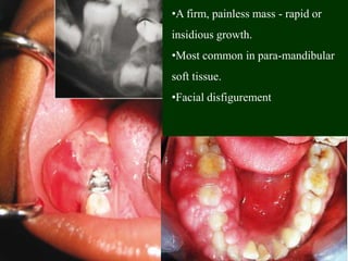 •A firm, painless mass - rapid or
insidious growth.
•Most common in para-mandibular
soft tissue.
•Facial disfigurement
 