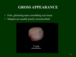 GROSS APPEARANCE
• Firm, glistening mass resembling scar tissue
• Margins are usually poorly circumscribed
45
 