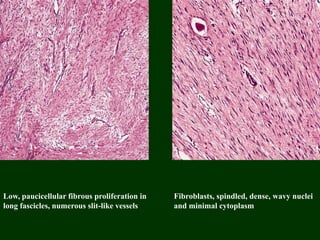 Low, paucicellular fibrous proliferation in
long fascicles, numerous slit-like vessels
Fibroblasts, spindled, dense, wavy nuclei
and minimal cytoplasm
 