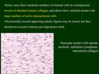 •Some cases show moderate numbers of lesional cells in a background
stroma of abundant mature collagen, and others show minimal stroma with
large numbers of active mesenchymal cells.
•Occasionally normal-appearing mitotic figures may be found, but they
should not exceed 4 mitoses per high-power field.
Vesicular nuclei with minute
nucleoli, indistinct cytoplasm,
interstitial collagen
 