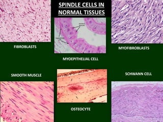 FIBROBLASTS MYOFIBROBLASTS
SMOOTH MUSCLE SCHWANN CELL
OSTEOCYTE
MYOEPITHELIAL CELL
SPINDLE CELLS IN
NORMAL TISSUES
 