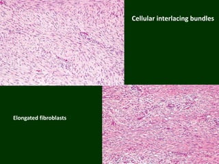 Cellular interlacing bundles
Elongated fibroblasts
 