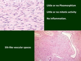 Little or no Pleomorphism
Little or no mitotic activity
No inflammation.
Slit-like vascular spaces
 