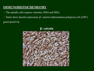 IMMUNOHISTOCHEMISTRY
The spindle cells express vimentin, SMA and MSA
Some show desmin expression, β- catenin (adenomatous polyposis coli (APC)
gene) positivity
β- catenin
 