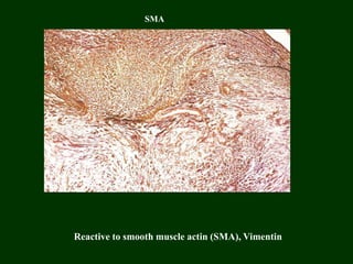 Reactive to smooth muscle actin (SMA), Vimentin
SMA
 