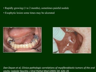 • Rapidly growing (1 to 2 months), sometimes painful nodule
• Exophytic lesion some times may be ulcerated
Dan Dayan et al, Clinico-pathologic correlations of myofibroblastic tumors of the oral
cavity: nodular fasciitis; J Oral Pathol Med (2005) 34: 426–35
 
