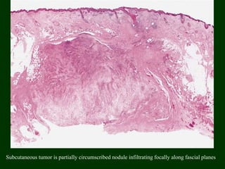 Subcutaneous tumor is partially circumscribed nodule infiltrating focally along fascial planes
 