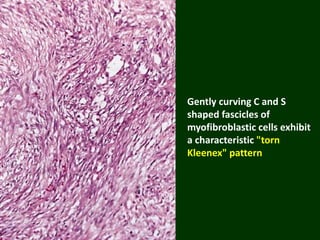 Gently curving C and S
shaped fascicles of
myofibroblastic cells exhibit
a characteristic "torn
Kleenex" pattern
 