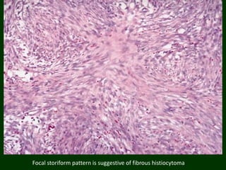 Focal storiform pattern is suggestive of fibrous histiocytoma
 